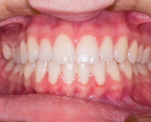 Gingivitis – So erkennt man sie und so wird sie behandelt