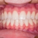 Gingivitis – So erkennt man sie und so wird sie behandelt