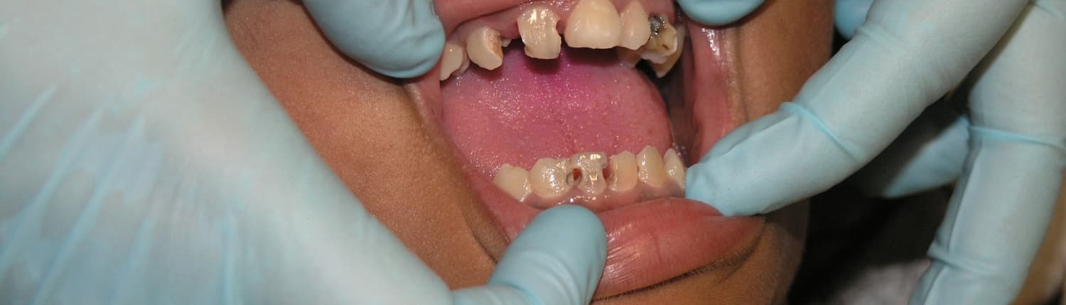 Abrasionsgebiss