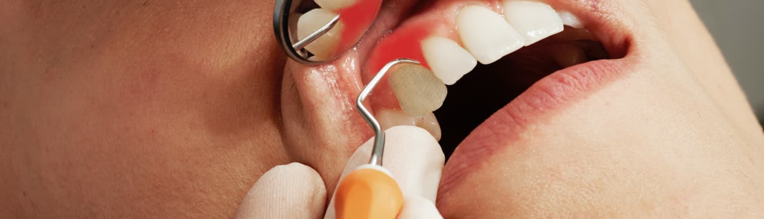 Zahnfleisch – der wirksamste Schutz für den Zahnhals