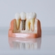 Zahnersatz erfordert sorgfältige Zahn- und Mundhygiene