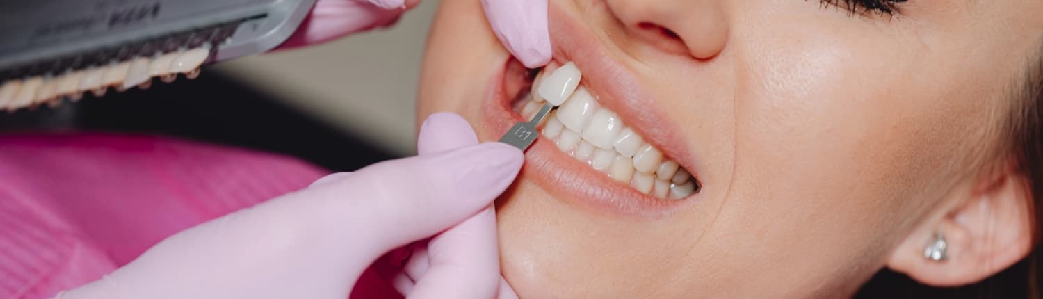 Verblendschalen bei Zahnschäden: Veneers