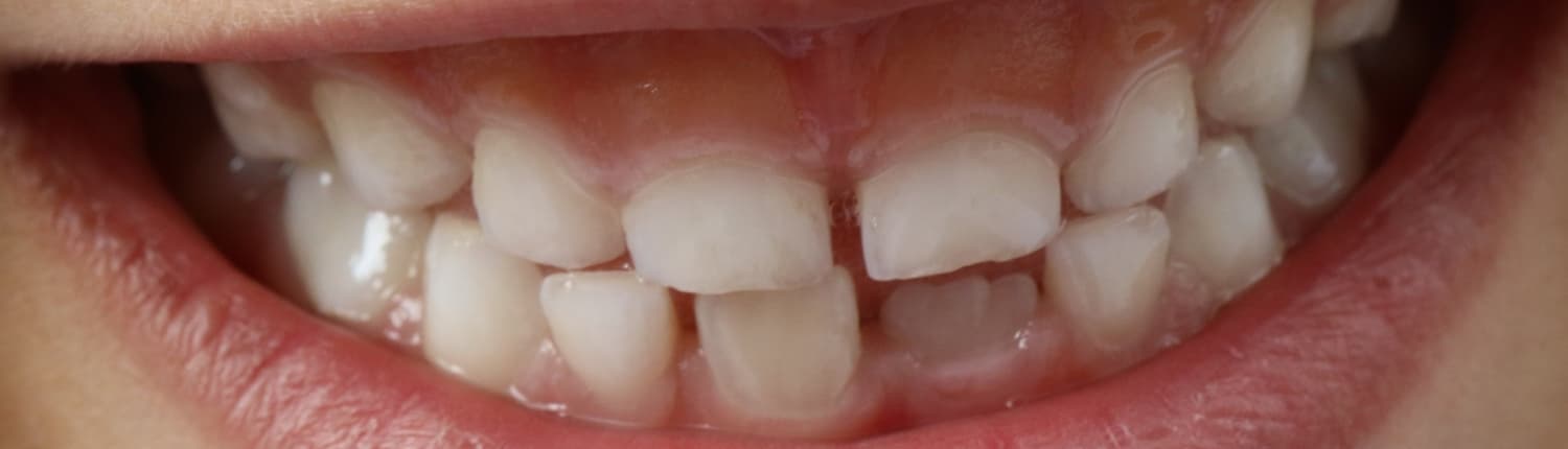 Milchzahnendodontie
